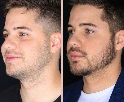 Hair Transplant in Dubai