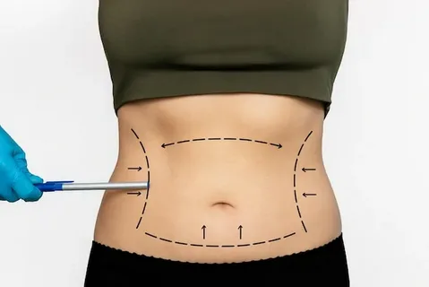 Liposuction in Dubai