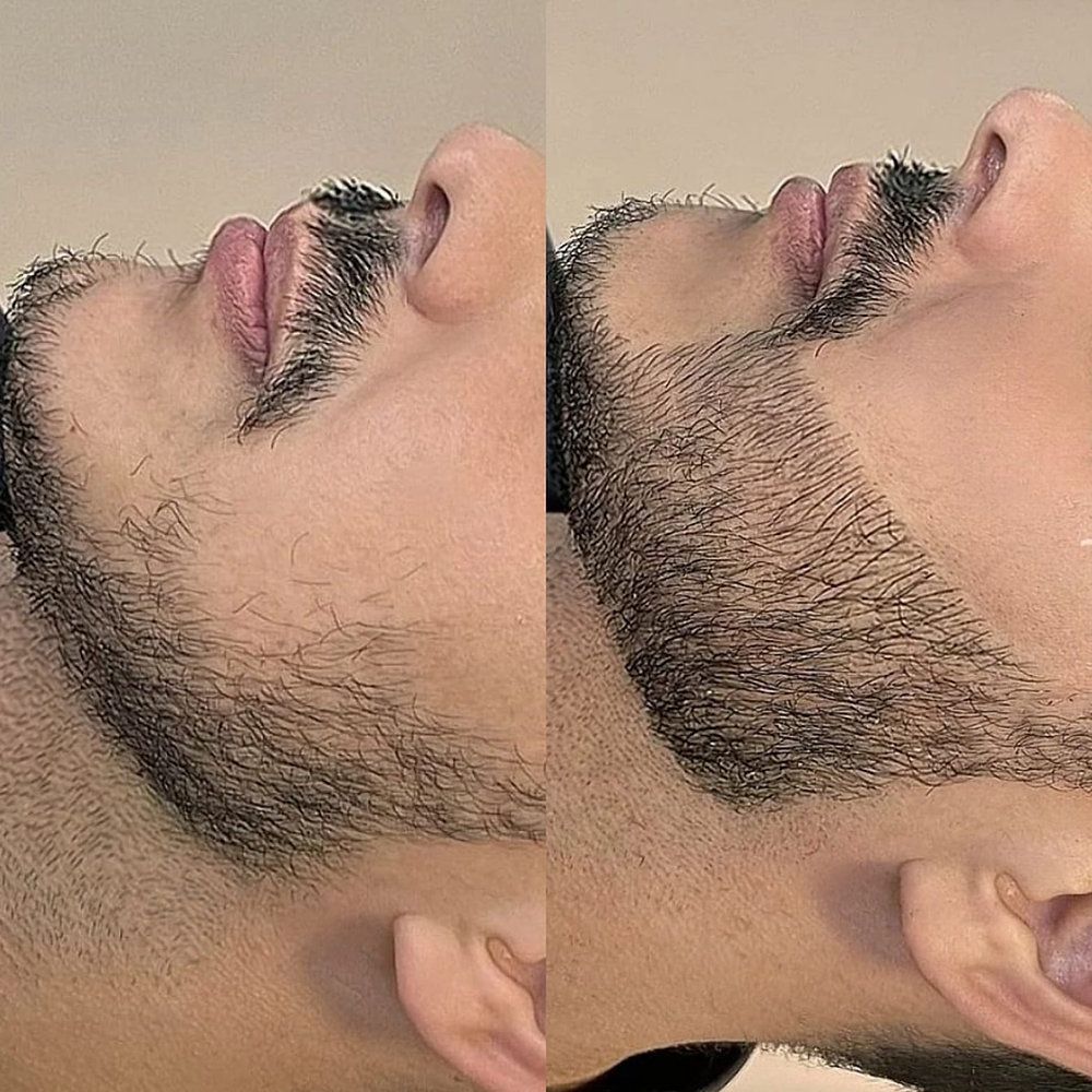 Beard hair transplant in dubai