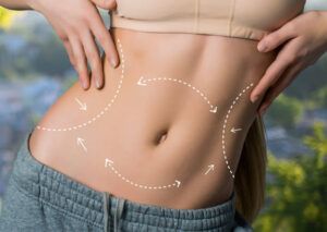 Liposuction in Dubai