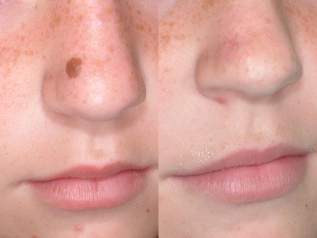 Birthmark Removal in Dubai