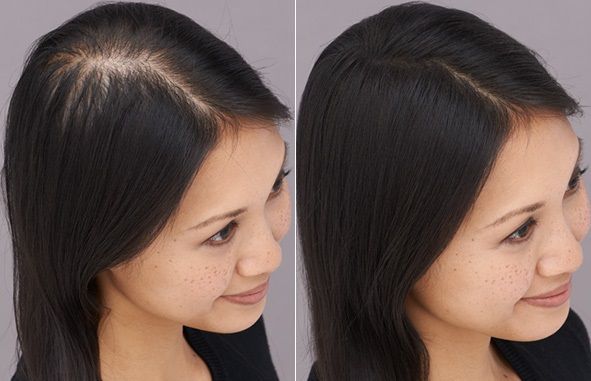 Hair Transplant in Dubai