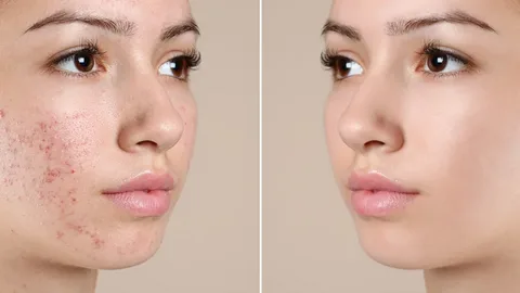 Pimples Treatment in Dubai