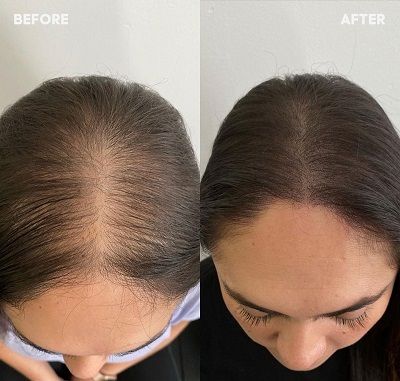 PRP Hair Treatment in Dubai 