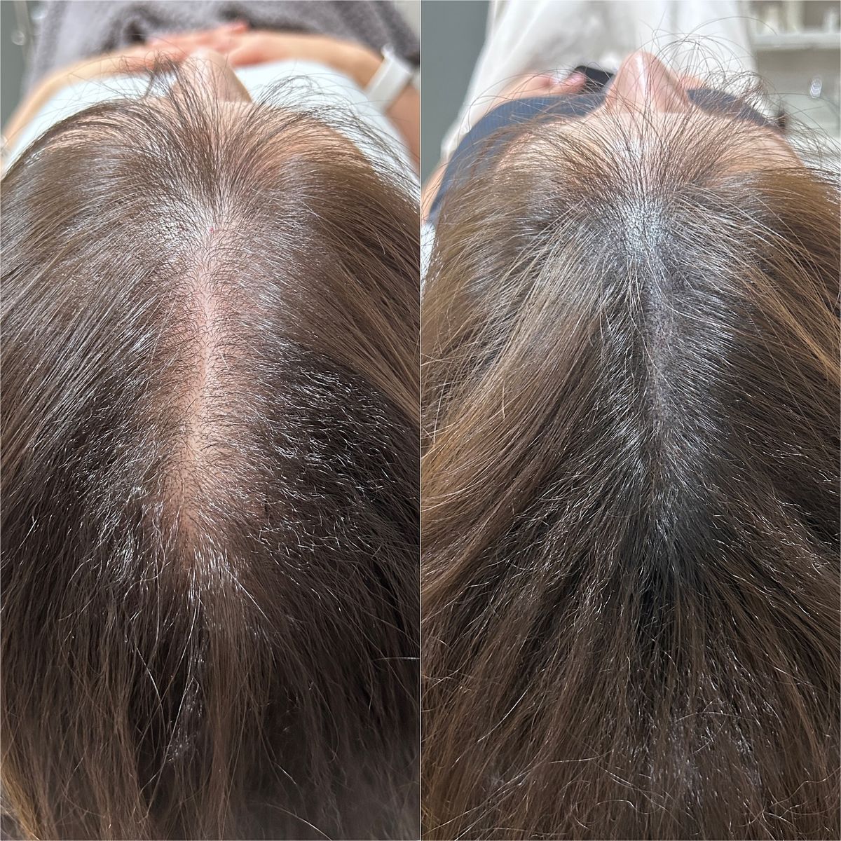 Hair Transplant in Dubai