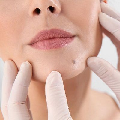 Mole removal in Dubai
