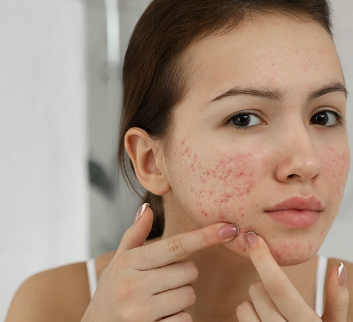 Pimples Treatment in Dubai