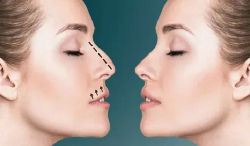 Rhinoplasty in Dubai: