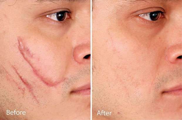 Scar Removal in Dubai: