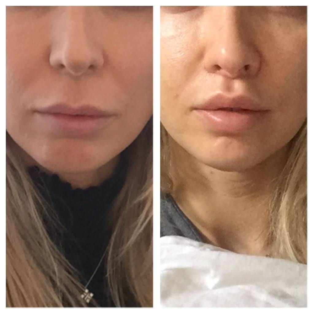 Bullhorn Lip Lift in Dubai