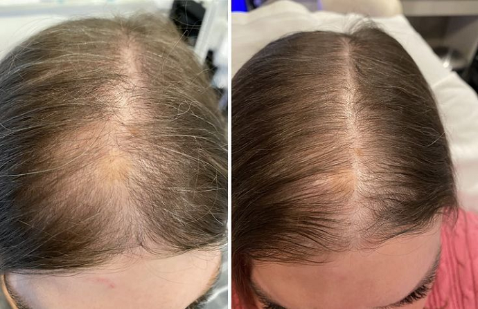 Hair Transplant in Dubai