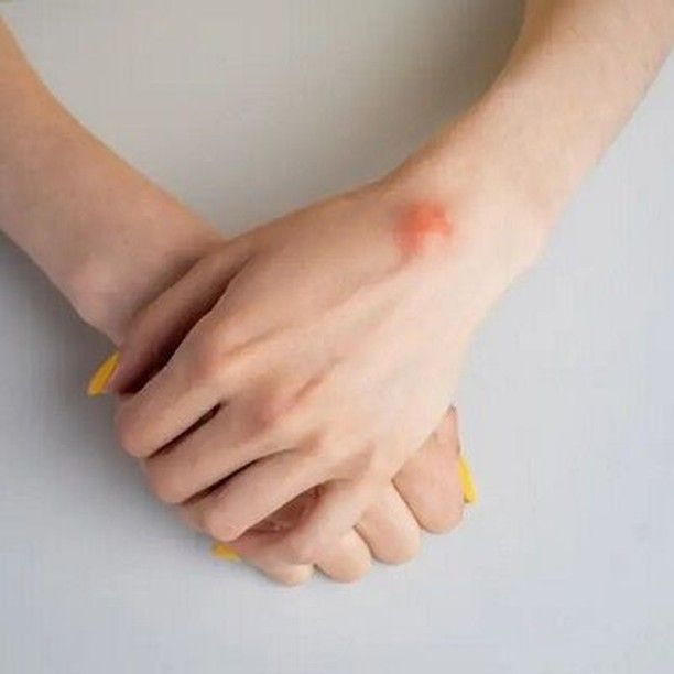 Lipoma Treatment in Dubai
