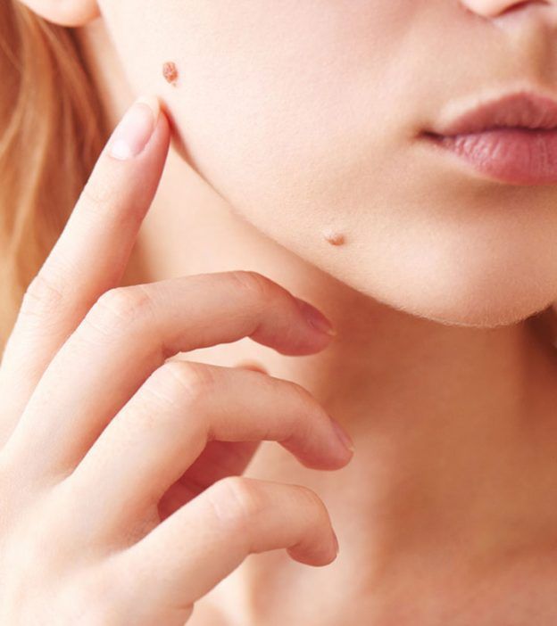 Mole Removal in Dubai