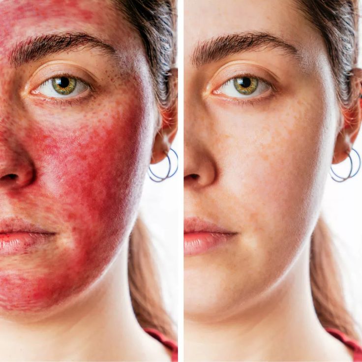 Vampire Facelift in Dubai