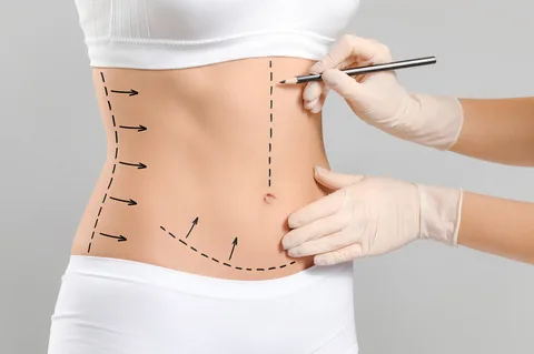 High Definition Liposculpture in Dubai
