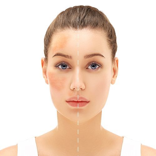 Birthmark Removal in Dubai