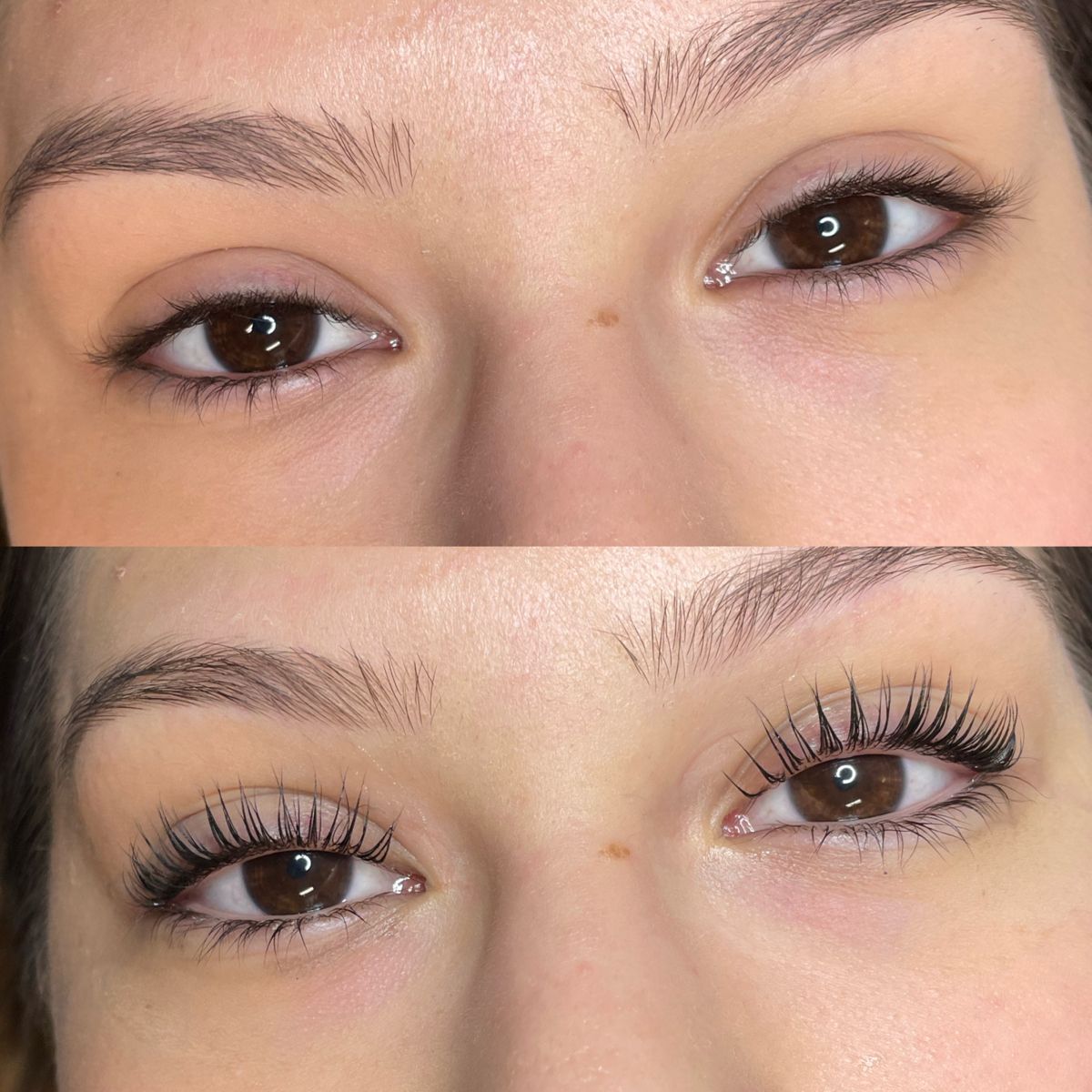 Eyelash Hair Transplant in Dubai