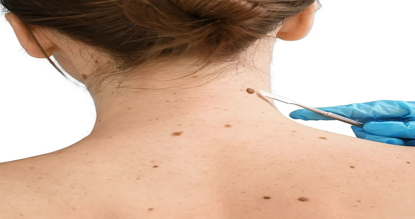 Mole removal in Dubai