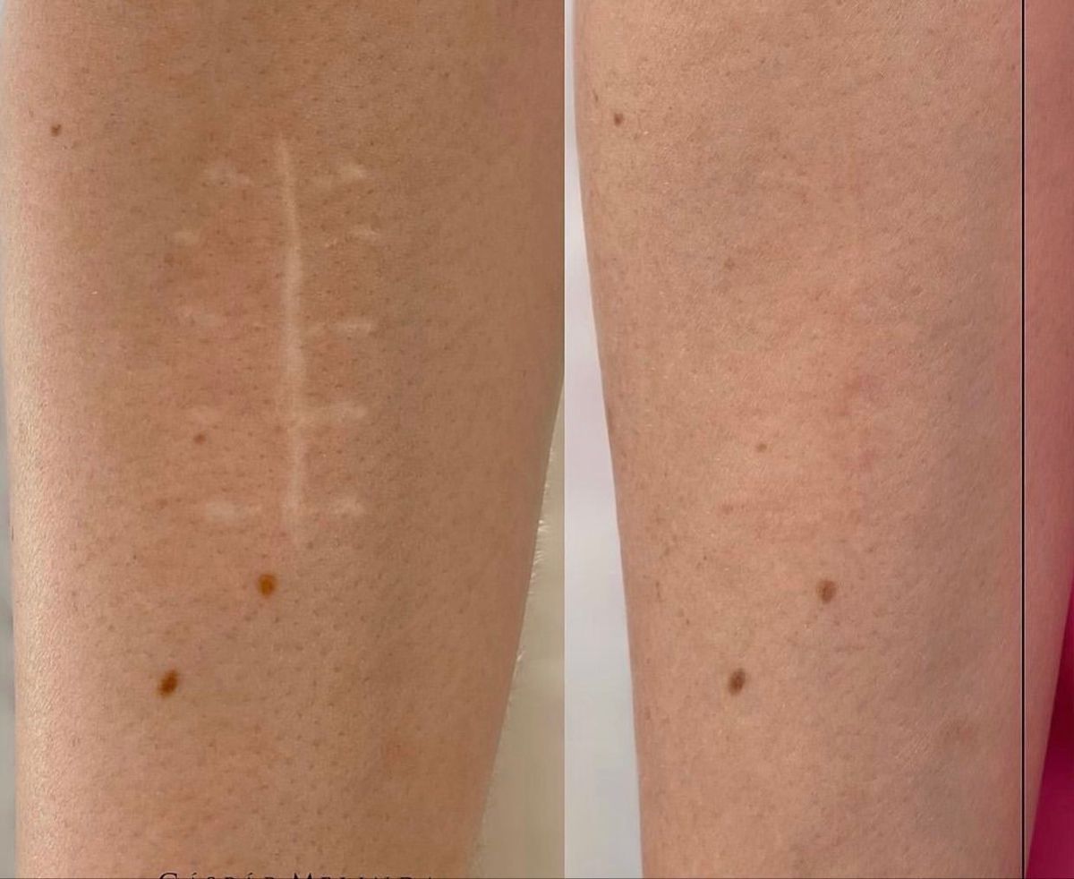 Laser Scar Removal in Dubai