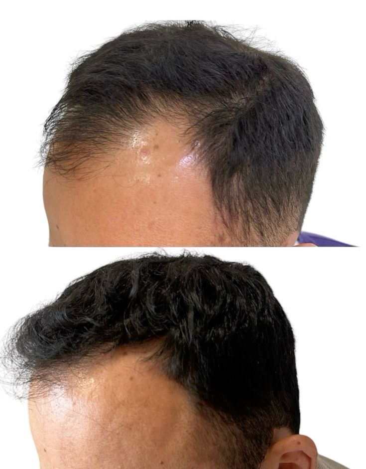 Hair Transplant Dubai