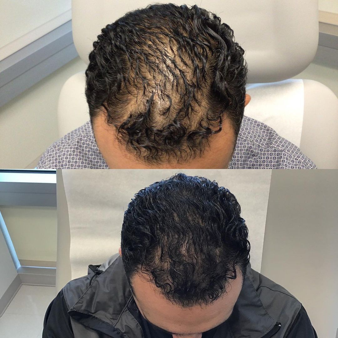 Scarless Hair Transplant in Dubai