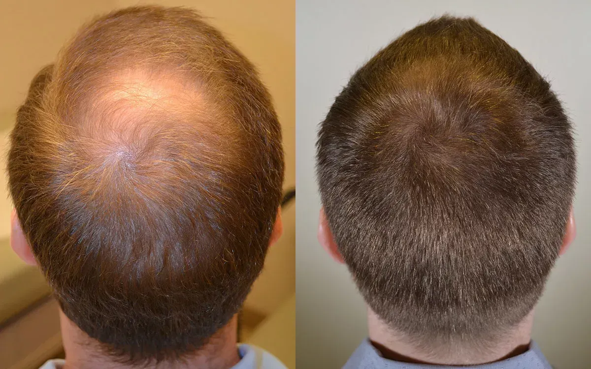 1 Dirham Hair Transplant in Dubai