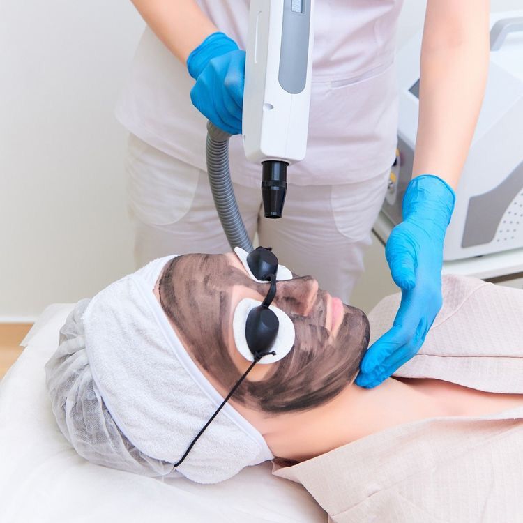 Spectra Laser Carbon Peeling in Dubai