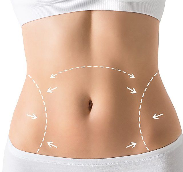 Liposuction in Dubai