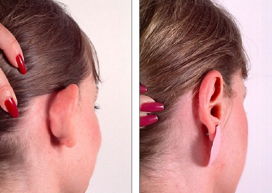 Ear reshaping in Dubai