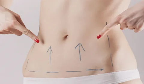 Mini Abdominoplasty in Dubai