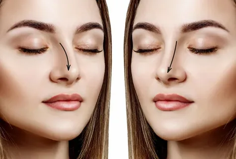 Rhinoplasty in Dubai