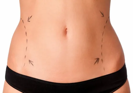Liposuction in Dubai