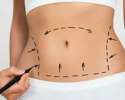 Liposuction in Dubai